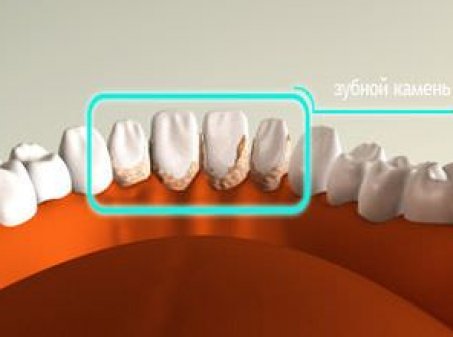 Как избавиться от зубного камня в домашних условиях