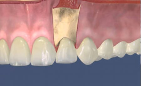 Что такое резекция верхушки корня зуба